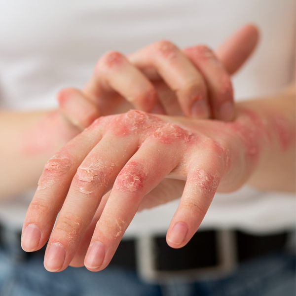 dermatika-elki-squre-image dermatika elki squre image